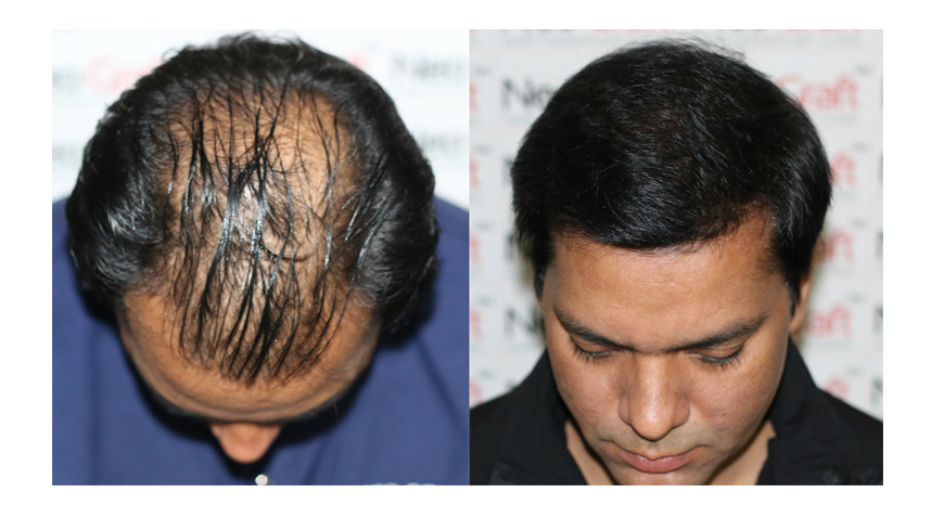 BEST HAIR TRANSPLANT IN INDIA - best hair transplant in india